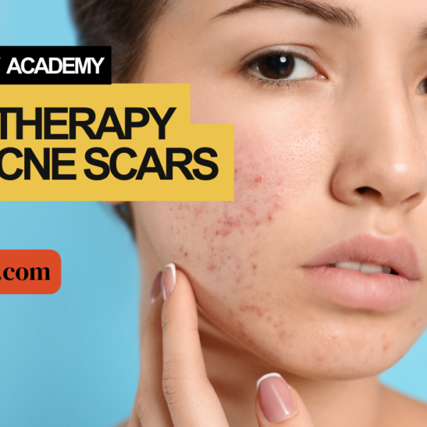Mesotherapy for Acne Scars