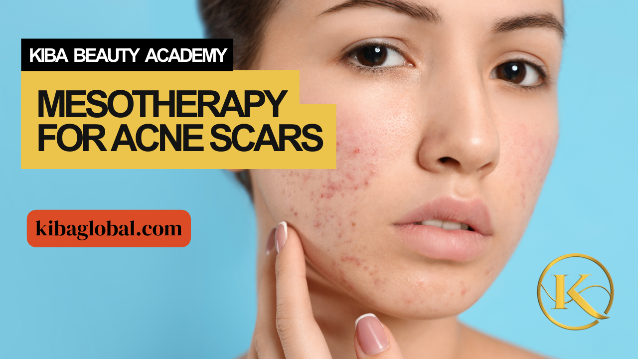Mesotherapy for Acne Scars
