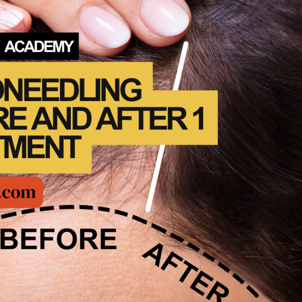 Microneedling Before and After