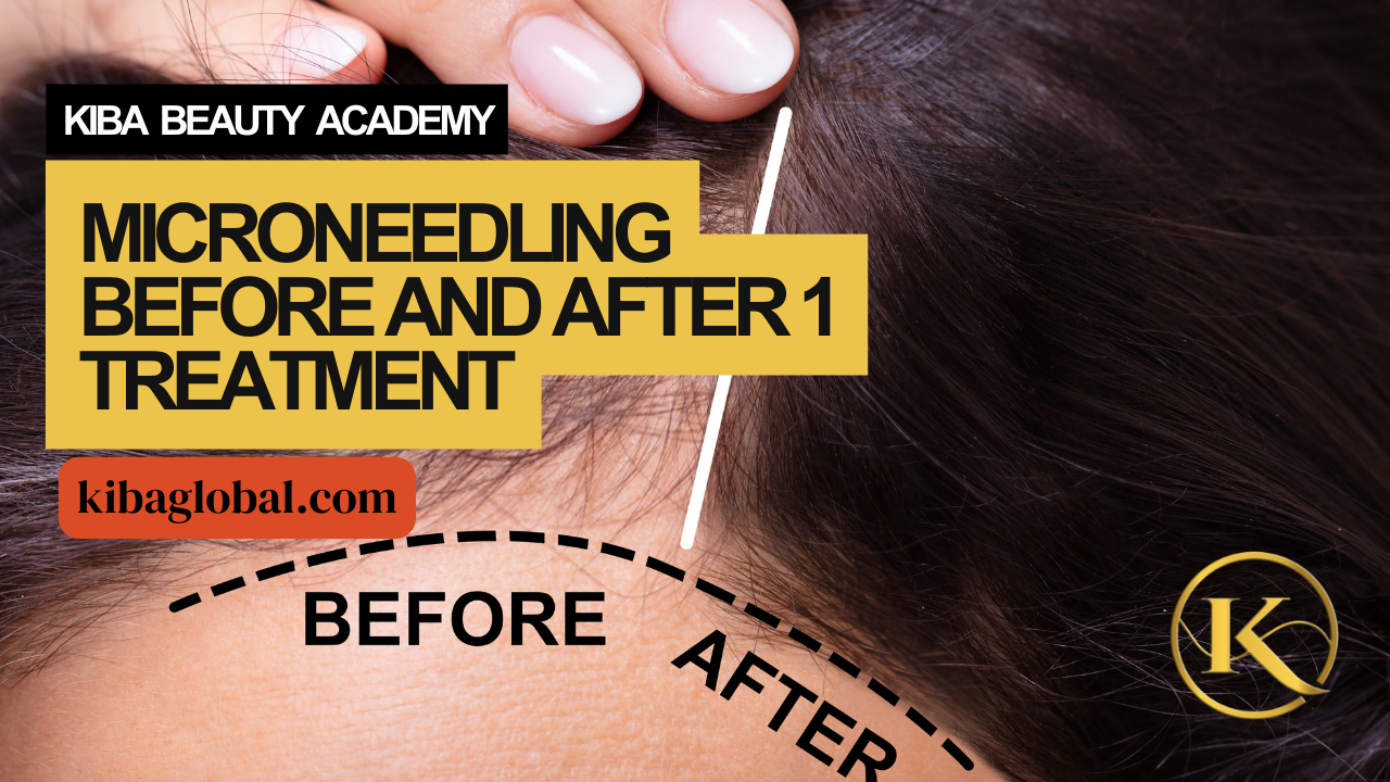 Microneedling Before and After 1 Treatment
